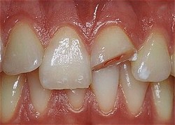 Before restoration Before crown