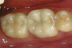 After restoration After restoration