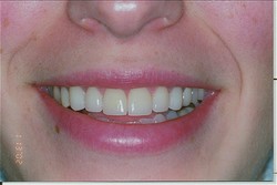 After veneers