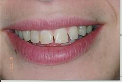 Before veneers