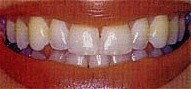 Before whitening